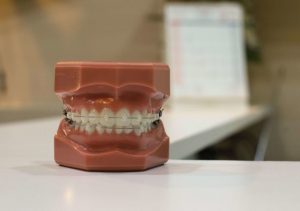 rolul-aparatului-dentar-si-ce-alegeri-poti-face
