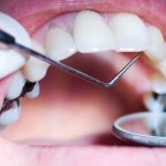 Cum iti afecteaza dintii consumul de droguri?