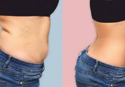 abdominoplastie_fb