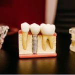 Implantologie dentară: cum să te bucuri din nou de o dantură completă?